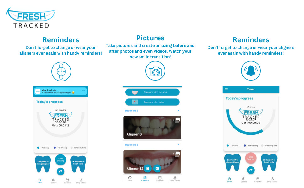 Invisalign Tracking