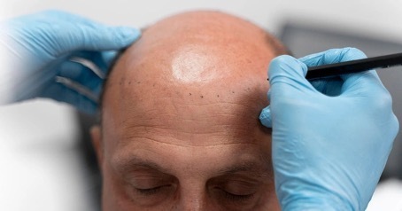 FUE Technique Hair Transplant in Turkey​​ 