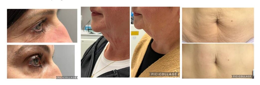 B.A.R.E. Essentials Spa is a medical laser spa located in Tecumseh, Ontario, offering advanced skin and body treatments using medical-grade technology.