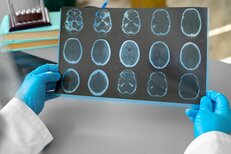 Vital Reset in Hood River Oregon Psilocybin Treatment for Parkinsons Disease