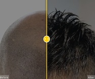 In this picture we show a young male from bald to having hair back using folicure solution for balding men of any age. 