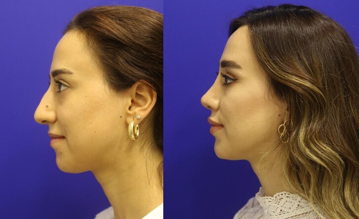 M.D. Ozan Balık - Finding The Best Rhinoplasty Surgeon