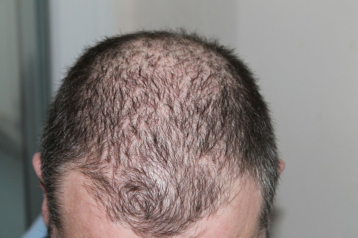 Round Rock, TX Best Non-Surgical Hair Replacement Results Attracting More New Clients - KISS Best Hair Loss Report