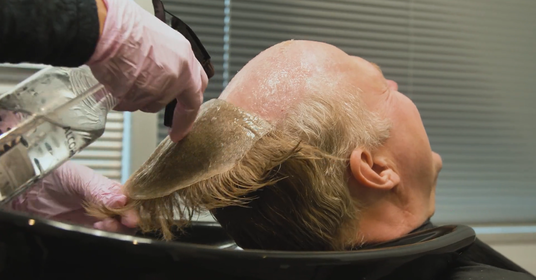 Dallas hair replacement experts from Folicure - Are you a Good Candidate for Hair Replacement?