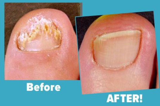 How Long Does It Take To Get Rid Of Toenail Fungus? Crystal Flush Anti-Fungal Experts Answer.