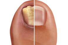 How Fungus Destroys Your Nails. Crystal Flush Toe Anti-Fungal Experts Explain.